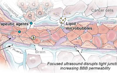 Illustration depicting how focused ultrasound works.