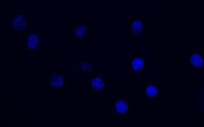 Glioblastoma Cells Responding to Treatment!