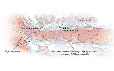 Illustration showing how focused ultrasound disrupts the blood-brain barrier.