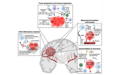 Cartoon illustration showing the immune microenvironment in glioblastoma.