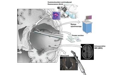 Illustration showing the methods to identify of tumor margins intraoperatively. AI could help improve the speed and accuracy of simulated Raman histology. 